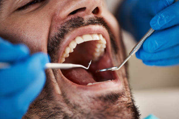 Best Emergency Root Canal Treatment in Stoneville, NC
