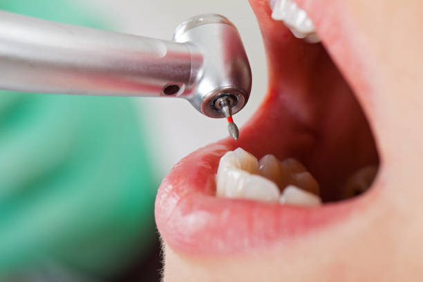 Best Emergency Tooth Extraction in Stoneville, NC